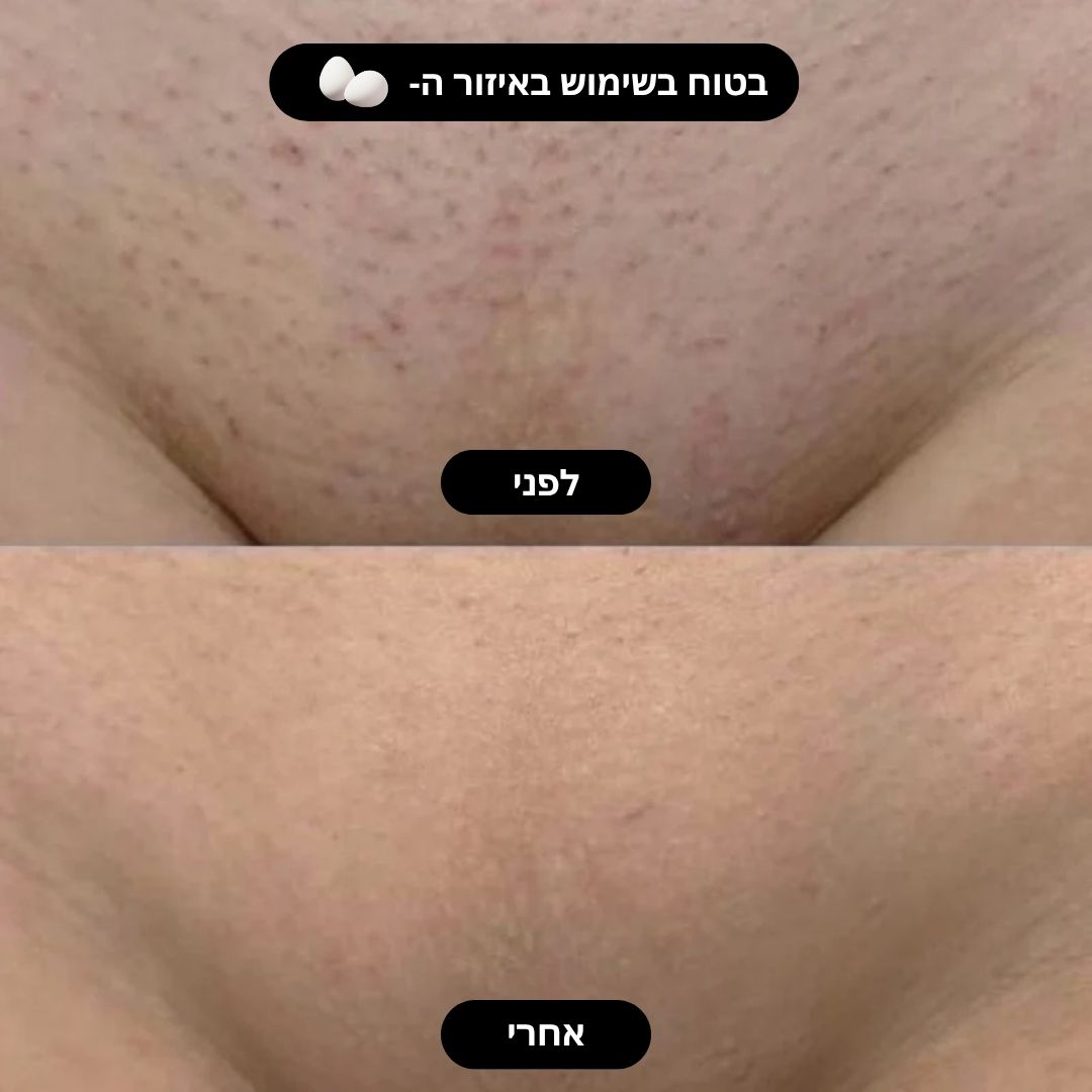 מכונת הגילוח Wisher - לביצים ולגוף